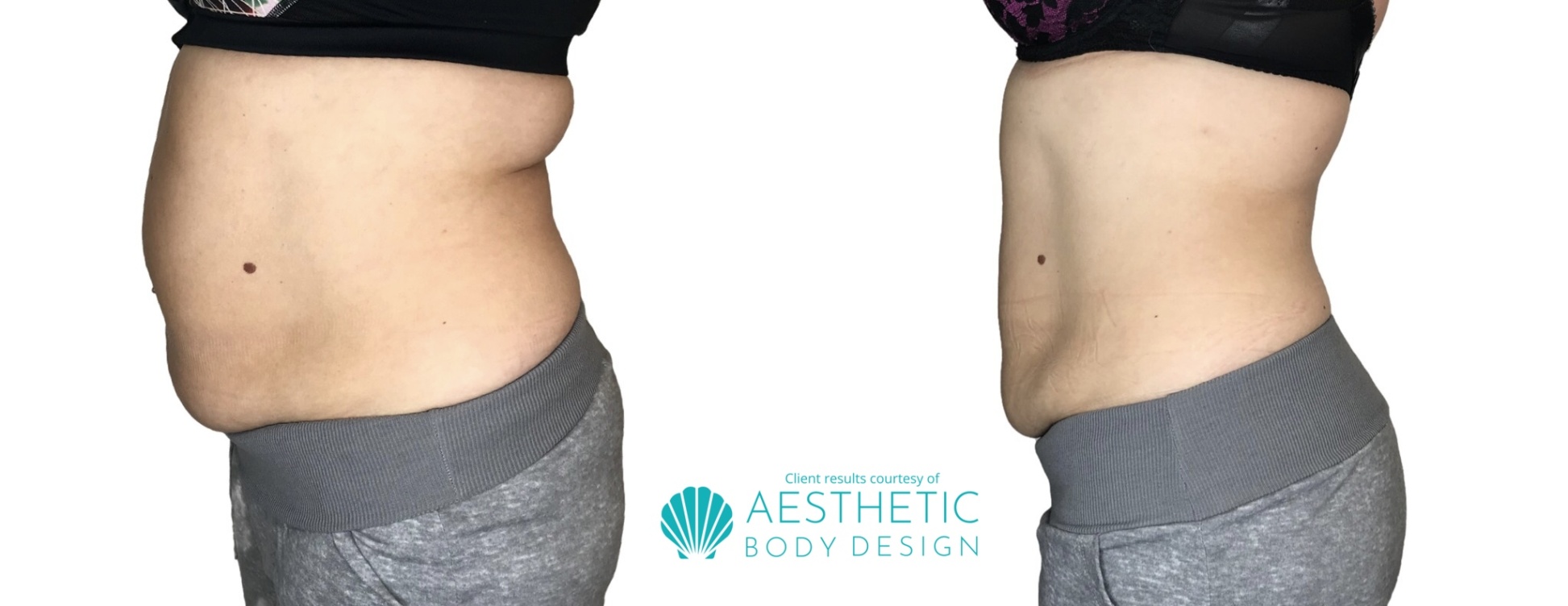 aesthetic body design Bulan 3 Before + After Gallery - Aesthetic Body Design