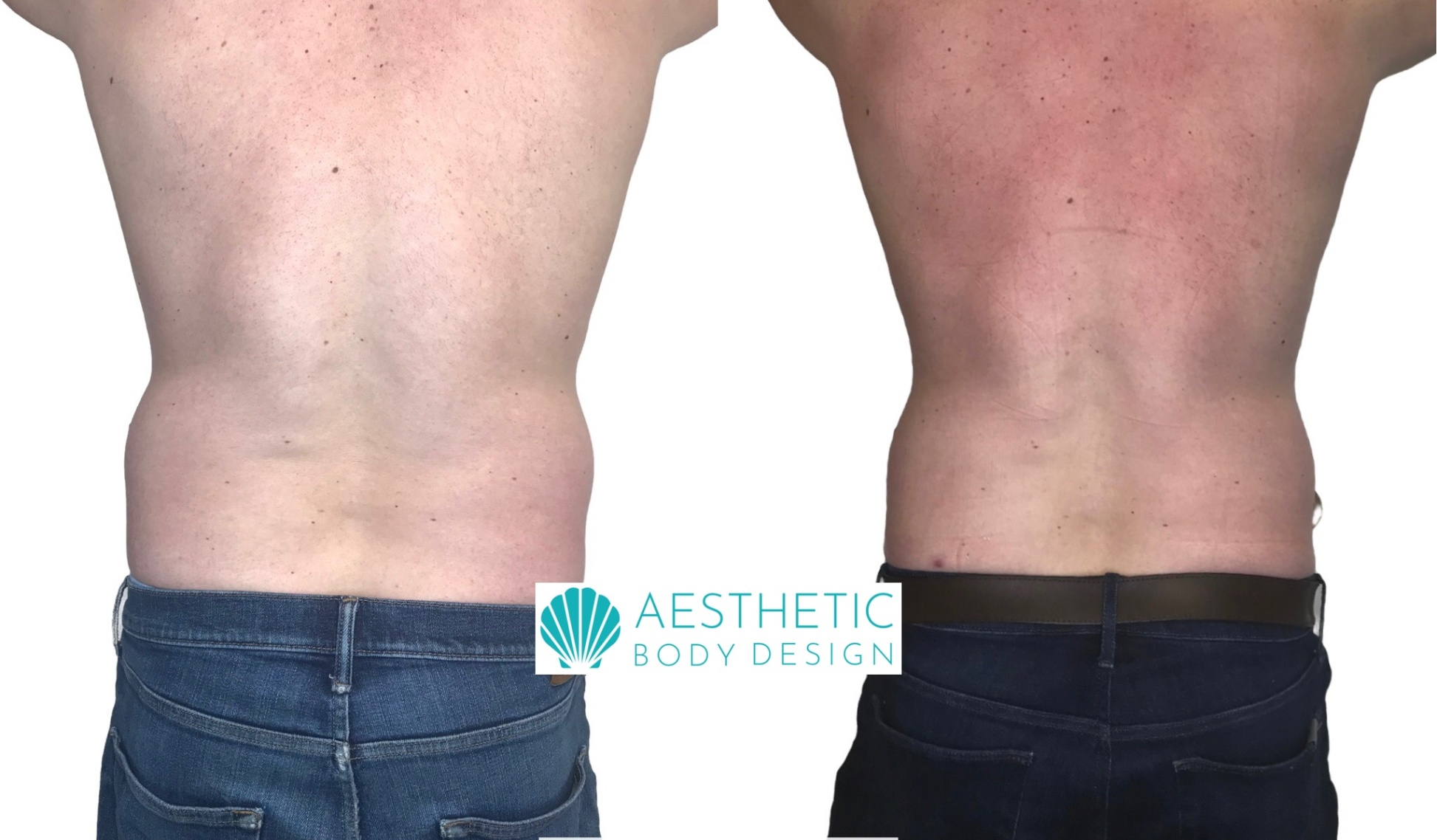 aesthetic body design Bulan 3 Before + After Gallery - Aesthetic Body Design